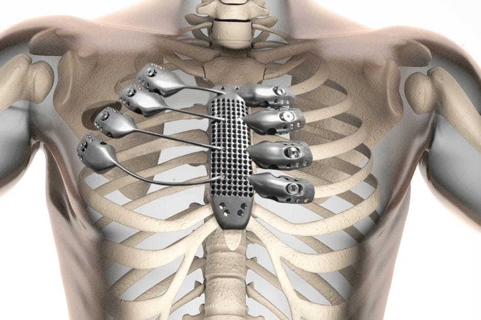 Implante de caixa torácica e esterno impresso em 3D